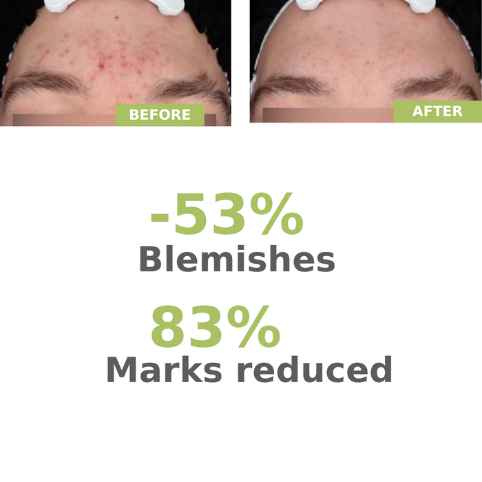 Aderma Biology AC Night Peel Serum 30ML